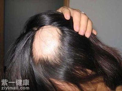 短时间脱发的原因有哪些 专家帮你细加甄别致病原因