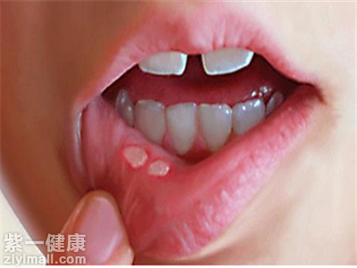中医如何治疗口腔溃疡 中医治疗口腔溃疡的辨证方法推荐_紫一商城
