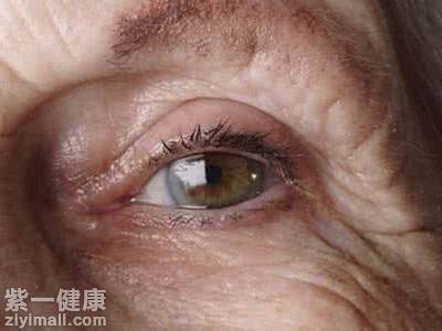 老人视物模糊的原因有哪些 看不清楚小心4种眼科疾病