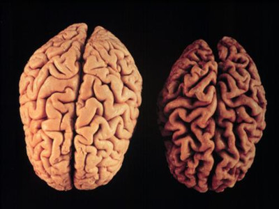 小脑萎缩的症状有哪些 为你揭秘小脑萎缩的具体症状