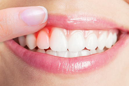 牙龈经常出血是什么原因 引起牙龈出血的3大因素