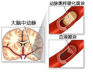 哪些原因会导致脑血栓的出现
