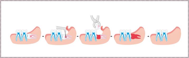 拔除智齿