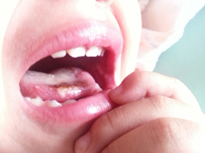 小孩脑萎缩的原因有哪些