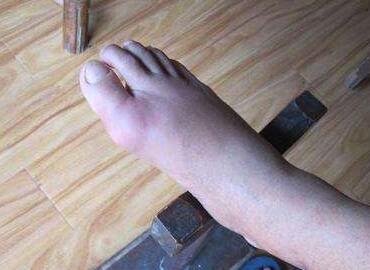 脚的大拇指疼是怎么回事要如何解决