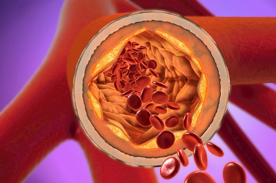 image 血脂高不高看腿就知道